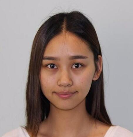 beforeafter医院:北京悦丽汇医疗美容诊所医生:周宜国