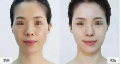 成都自体脂肪填充多少钱？