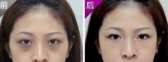 深圳激光去黑眼圈需要多少钱