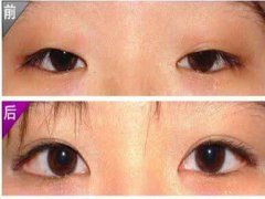 做开眼角的费用