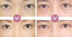 超声波去眼袋价格、果能保持多久