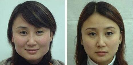 颧骨颧弓,整形,风险,注意事项
