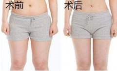 大腿吸脂有几个切口？大腿环吸几个切口？