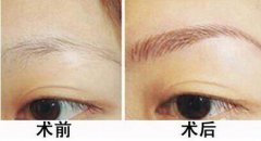 种植眉毛是怎么回事？种植眉毛有什么作用？