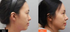 隆鼻多久消肿自然，术后多久能恢复？