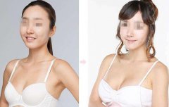 上海假体丰胸手术多少钱？上海假体丰胸价格？