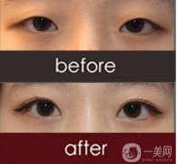 改脸型手术多少钱？改脸型手术有危险吗？