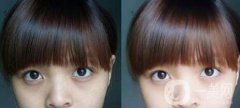黑眼圈可以打玻尿酸吗？玻尿酸去黑眼圈果如何？