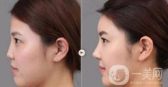 上海假体隆鼻多少费用？假体隆鼻价格详细分析