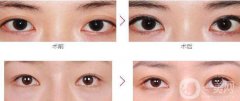 杭州割双眼皮价格贵不贵？价格是多少？