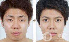 男士割双眼皮果怎样？有哪些方式？