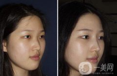 广东硅胶隆鼻需要多少钱呢？广东硅胶隆鼻价格？