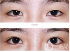 割双眼皮要多久恢复？割双眼皮恢复时间？