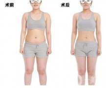 超声波吸脂减肥果怎么样？超声波吸脂减肥多少钱？　　