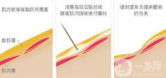 溶脂的价格一般是多少？溶脂一般多少钱？