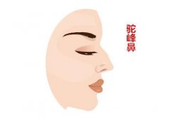 驼峰鼻矫正方法？如何矫正驼峰鼻