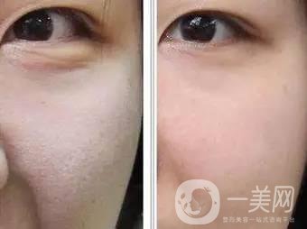 果酸换肤后注意事项盘点大揭秘，该怎么做？