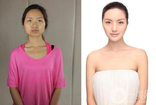 光子嫩肤有些什么*果和好处？