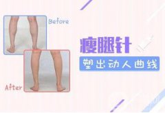 注射瘦腿会反弹吗 注射瘦腿果维持多久
