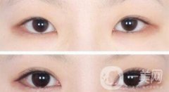韩式*开眼角多少钱  韩式*开眼角恢复图