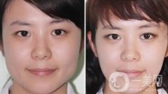 注射瘦脸*多少钱 注射瘦脸*价格详解