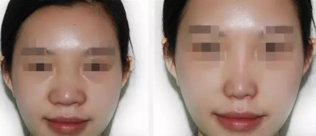 鼻翼缩小价钱 参考价格详情