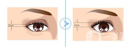 双眼皮眼部提肌的危害有哪些？