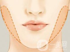 去颊脂垫多少钱 去颊脂垫价格一般是多少
