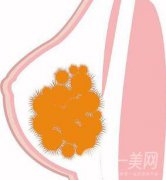 取出乳房奥美定果怎么样？取出*吗？