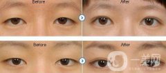 眼睛埋线后要注意什么 埋线获得漂亮双眼