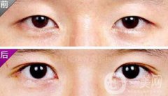 埋线双眼皮之后禁忌有哪些？具体注意事项介绍