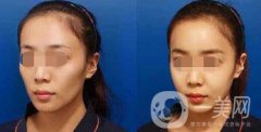 自体脂肪脸部填充可以做哪些部位