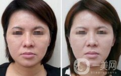 光子嫩肤适合多大年龄的人群