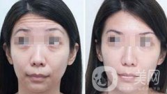 抬头纹能消除吗？用什么方法祛除抬头纹