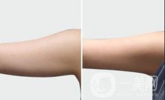 广东手臂吸脂需要多少钱?