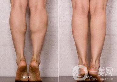 瘦小腿手术是怎么样的，具体方法有哪些