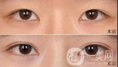 双眼皮拆线多久用疤克