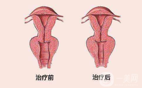 阴道紧缩手术的危害和原理分别是什么