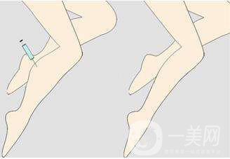 射频瘦小腿优缺点有哪些 射频瘦小腿方法