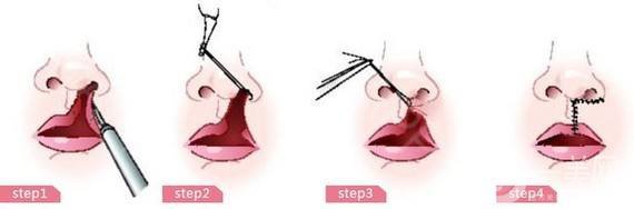 唇部扩大术是指什么 唇部扩大的作用是什么