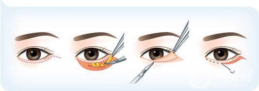 手术祛眼袋贵吗 祛眼袋的手术方式有哪些