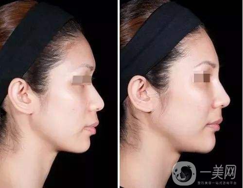 隆鼻的前后照片 隆鼻材料有哪些