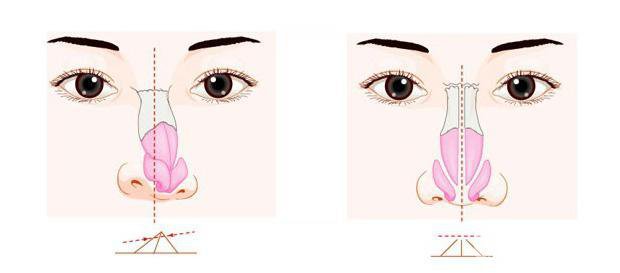 歪鼻矫正的成因 歪鼻矫正该如何调节？