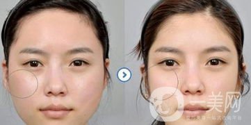 改变脸型手术要多少钱呢？