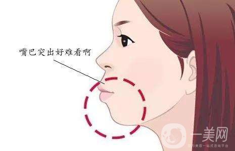 突嘴矫正的方法有哪些