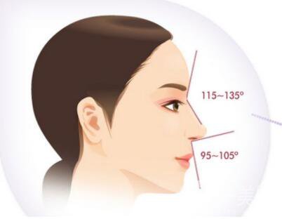 鼻成形术分为几种 肿胀持续到多久