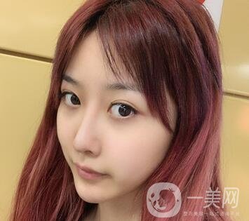 广州曙光医学美容医院价格表及肋软骨隆鼻案例分享