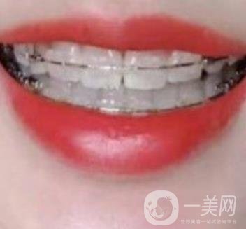 广东省口腔医院正畸价格表及案例恢复过程分享