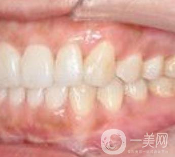 武汉大学口腔医院牙齿矫正多少钱?*果好吗?价格费用明细一览