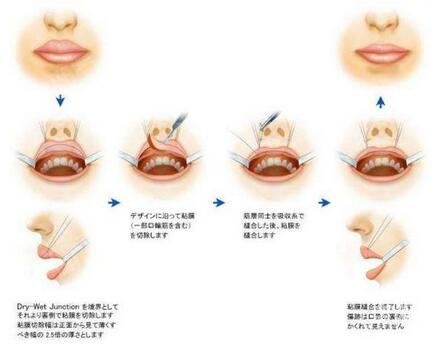 重唇修正前的注意事项?重唇修正后的注意事项?